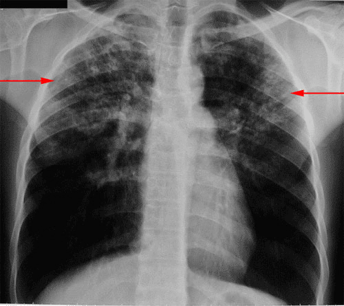 radio des poumons d'une tuberculose pulmonaire