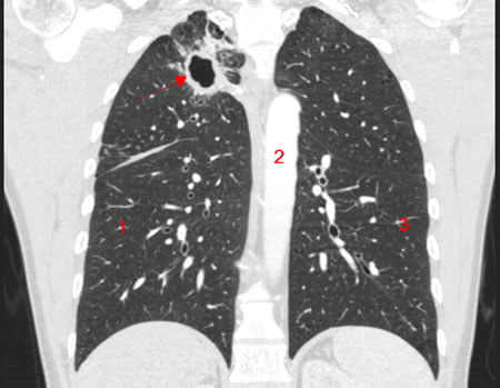 scanner du poumon cas de tuberculose
